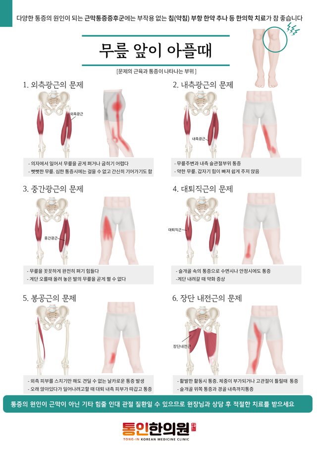 [근막통증증후군10]무릎앞이 아플때(a4).jpg